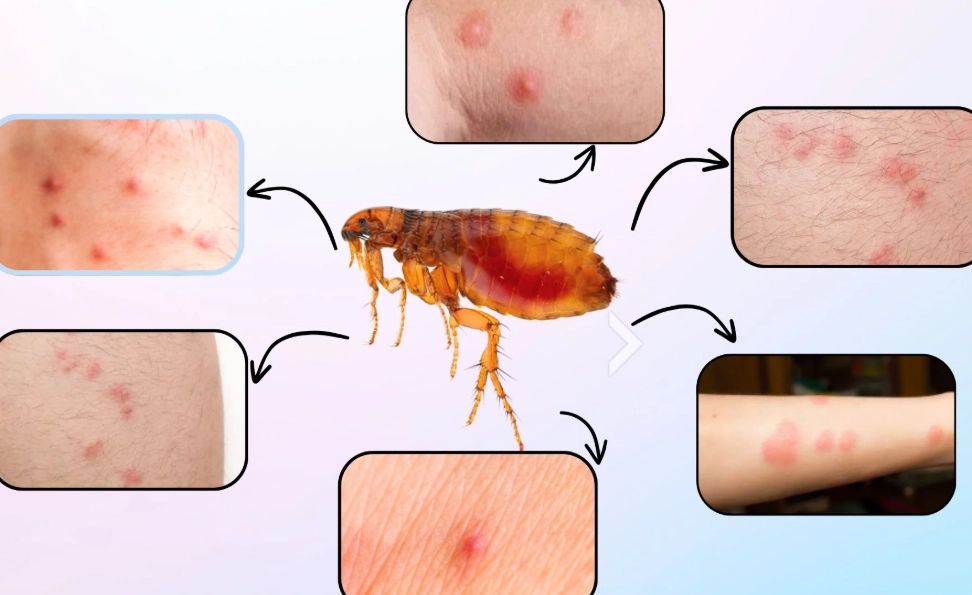 flea infestation humans flea infestation humans