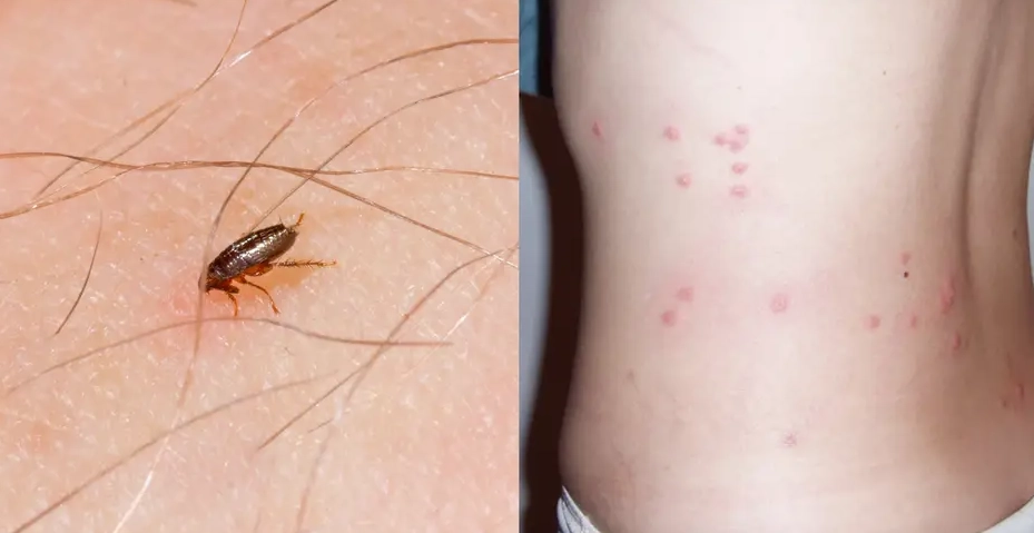 fleas on humans fleas on humans